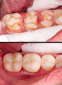 Dental restorations (prosthetics)