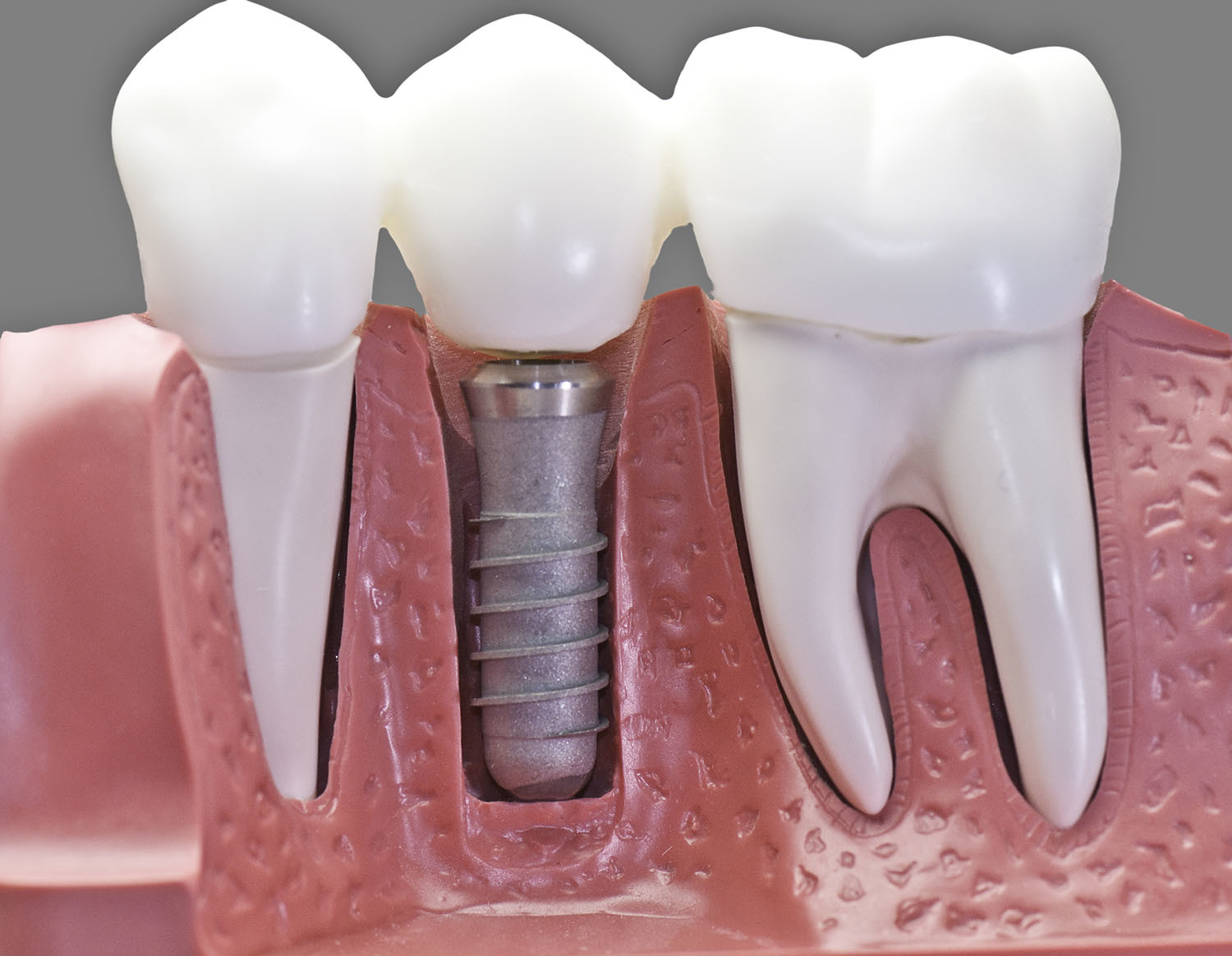 fogászati implantátum